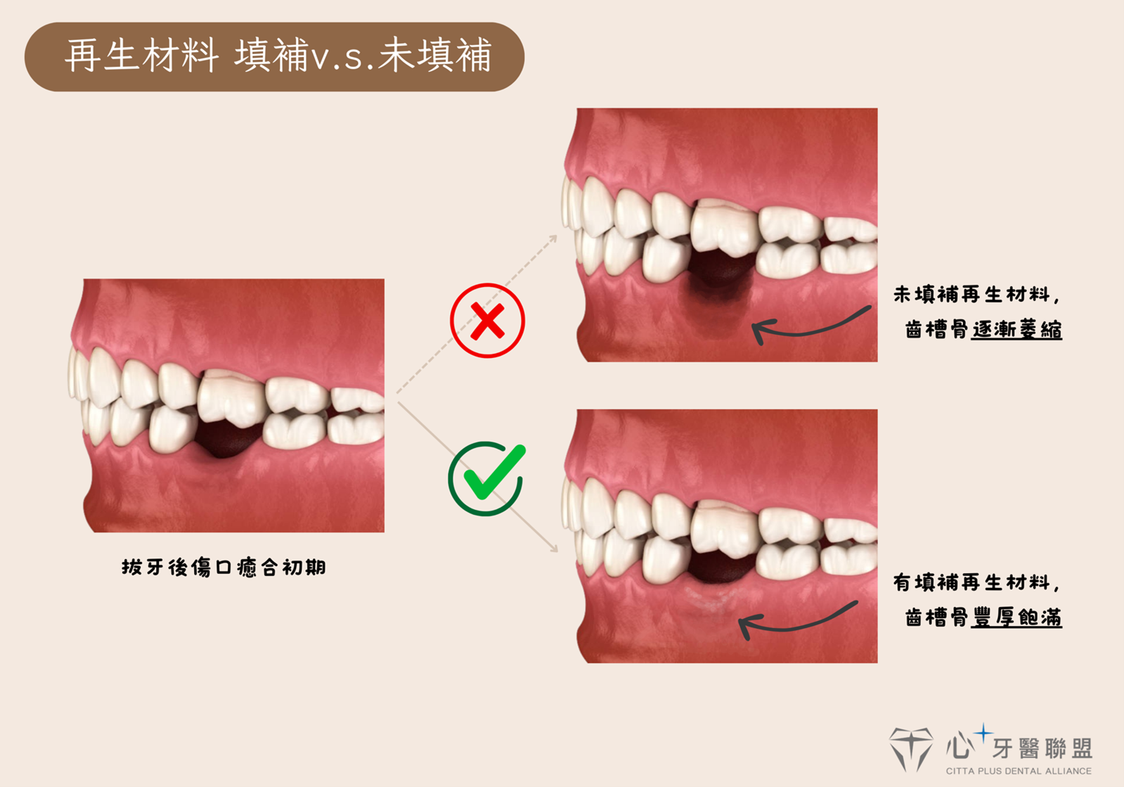 骨頭萎縮怎麼辦？齒槽骨保存術- 心⁺牙醫聯盟
