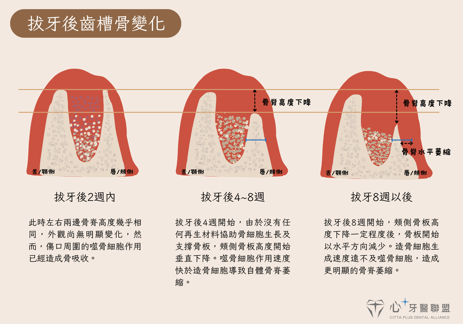 骨頭萎縮怎麼辦？齒槽骨保存術- 心⁺牙醫聯盟