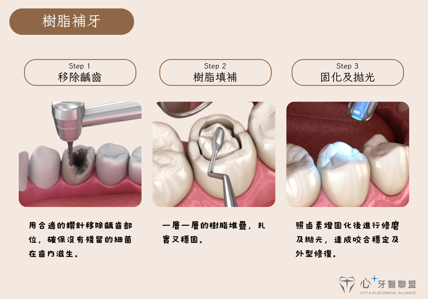 牙齒有一個洞，是不是要補蛀牙？ - 心⁺牙醫聯盟